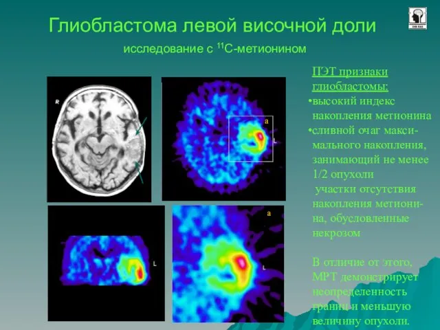 Глиобластома левой височной доли исследование с 11С-метионином ПЭТ признаки глиобластомы: высокий индекс