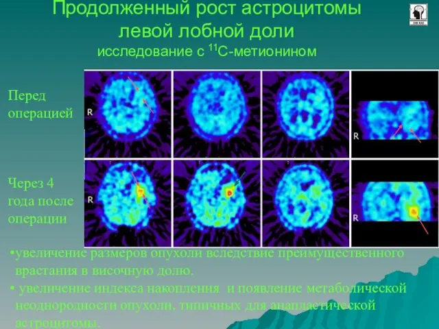 Продолженный рост астроцитомы левой лобной доли исследование с 11С-метионином увеличение размеров опухоли