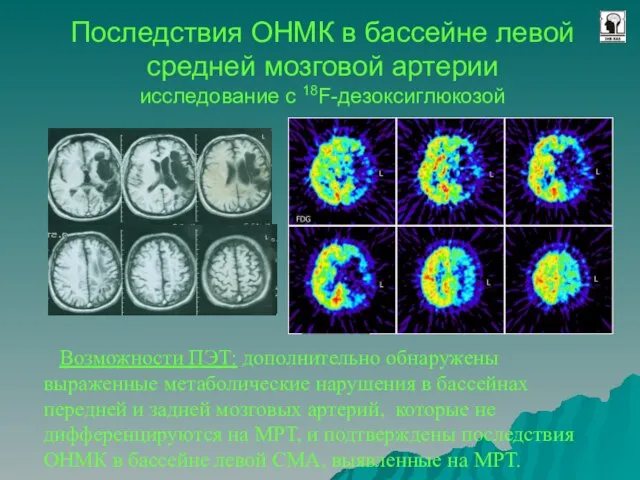 Последствия ОНМК в бассейне левой средней мозговой артерии исследование с 18F-дезоксиглюкозой Возможности