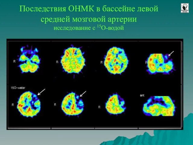 Последствия ОНМК в бассейне левой средней мозговой артерии исследование с 15O-водой