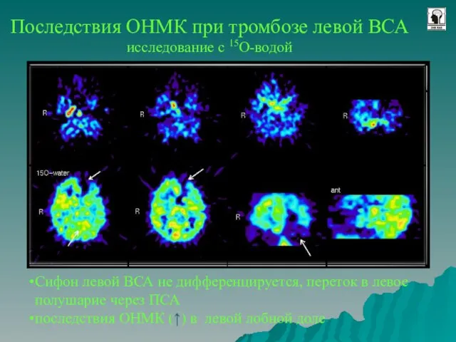 Последствия ОНМК при тромбозе левой ВСА исследование с 15O-водой Сифон левой ВСА