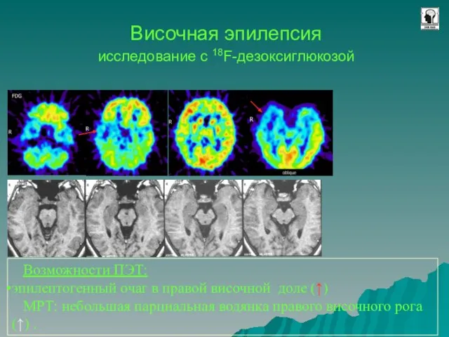 Височная эпилепсия исследование с 18F-дезоксиглюкозой Возможности ПЭТ: эпилептогенный очаг в правой височной