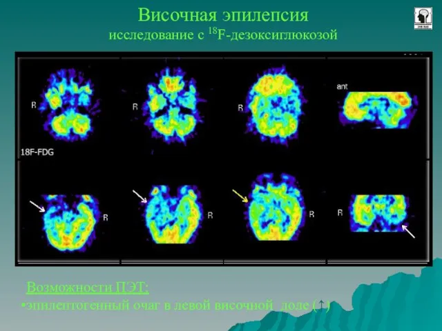 Височная эпилепсия исследование с 18F-дезоксиглюкозой Возможности ПЭТ: эпилептогенный очаг в левой височной доле (↑)