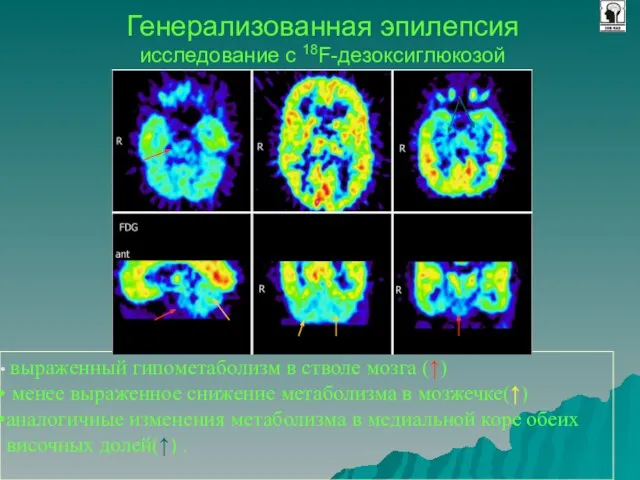 Генерализованная эпилепсия исследование с 18F-дезоксиглюкозой выраженный гипометаболизм в стволе мозга (↑) менее