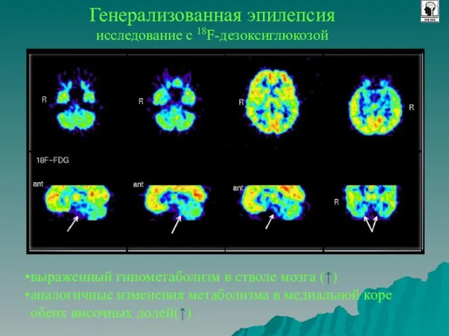 Генерализованная эпилепсия исследование с 18F-дезоксиглюкозой выраженный гипометаболизм в стволе мозга (↑) аналогичные
