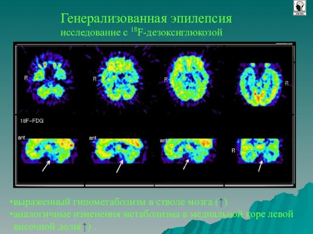 Генерализованная эпилепсия исследование с 18F-дезоксиглюкозой выраженный гипометаболизм в стволе мозга (↑) аналогичные