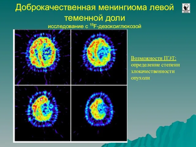 Доброкачественная менингиома левой теменной доли исследование с 18F-дезоксиглюкозой Возможности ПЭТ: определение степени злокачественности опухоли