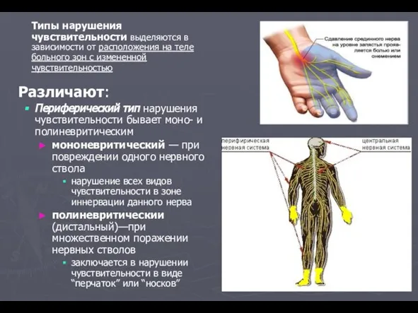 Различают: Периферический тип нарушения чувствительности бывает моно- и полиневритическим мононевритический — при