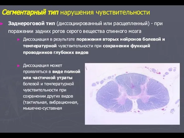 Заднероговой тип (диссоциированный или расщепленный) - при поражении задних рогов серого вещества