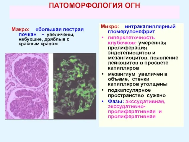 ПАТОМОРФОЛОГИЯ ОГН Макро: «большая пестрая почка» - увеличены, набухшие, дряблые с красным