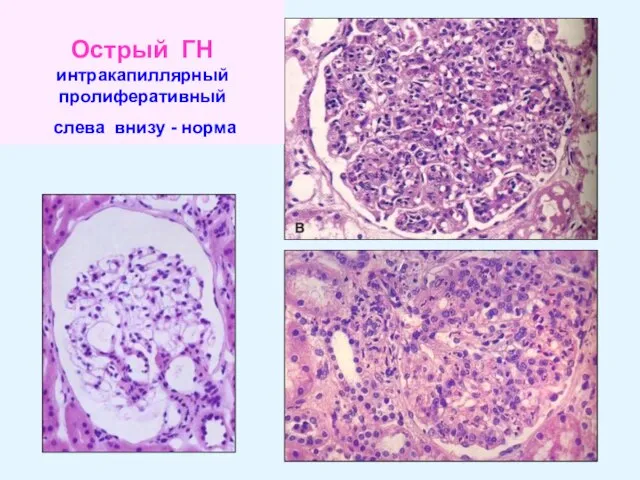 Острый ГН интракапиллярный пролиферативный слева внизу - норма