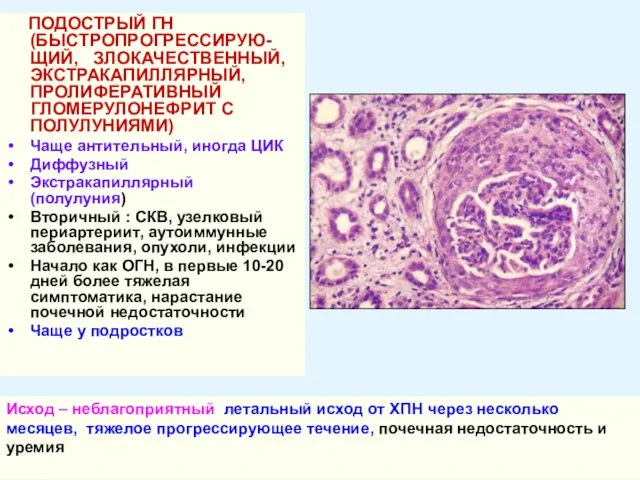 ПОДОСТРЫЙ ГН (БЫСТРОПРОГРЕССИРУЮ-ЩИЙ, ЗЛОКАЧЕСТВЕННЫЙ, ЭКСТРАКАПИЛЛЯРНЫЙ, ПРОЛИФЕРАТИВНЫЙ ГЛОМЕРУЛОНЕФРИТ С ПОЛУЛУНИЯМИ) Чаще антительный, иногда