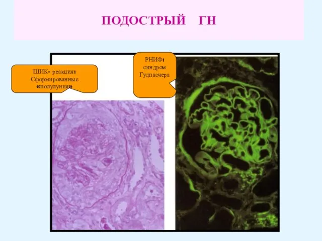 ПОДОСТРЫЙ ГН ШИК- реакция: Сформированные «полулуния» РНИФ: синдром Гудпасчера