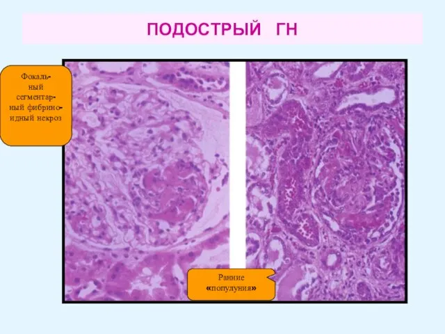 ПОДОСТРЫЙ ГН Фокаль- ный сегментар- ный фибрино-идный некроз Ранние «популуния»