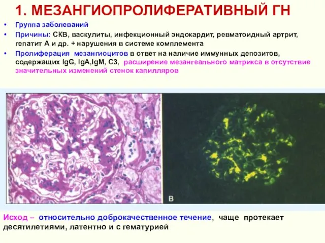 1. МЕЗАНГИОПРОЛИФЕРАТИВНЫЙ ГН Группа заболеваний Причины: СКВ, васкулиты, инфекционный эндокардит, ревматоидный артрит,