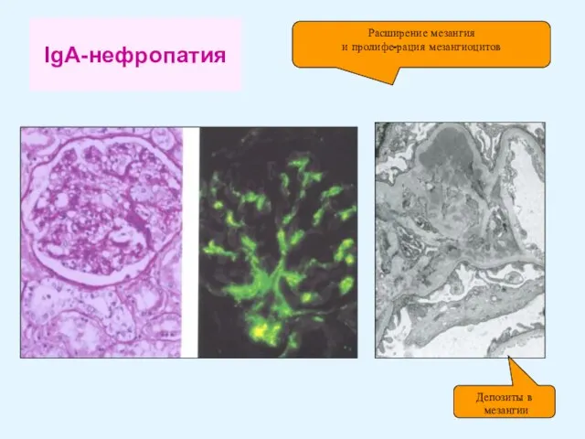 IgA-нефропатия Расширение мезангия и пролифе-рация мезангиоцитов Депозиты в мезангии