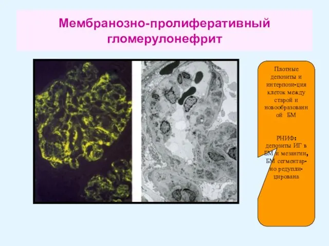 Мембранозно-пролиферативный гломерулонефрит Плотные депозиты и интерпози-ция клеток между старой и новообразованной БМ