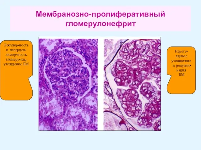 Мембранозно-пролиферативный гломерулонефрит Лобуляр-ность и гиперцел-люляр-ность гломеру-лы, утолщение БМ Нерегу-лярное утолще-ние и редупли-кация БМ