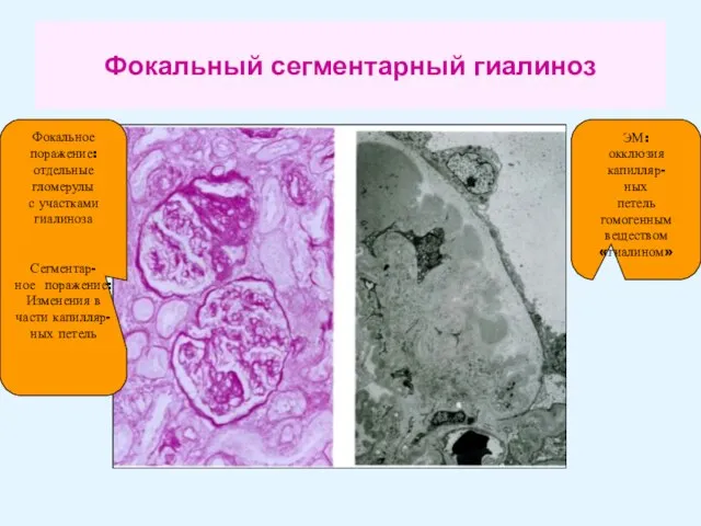 Фокальный сегментарный гиалиноз Фокальное поражение: отдельные гломерулы с участками гиалиноза Сегментар- ное