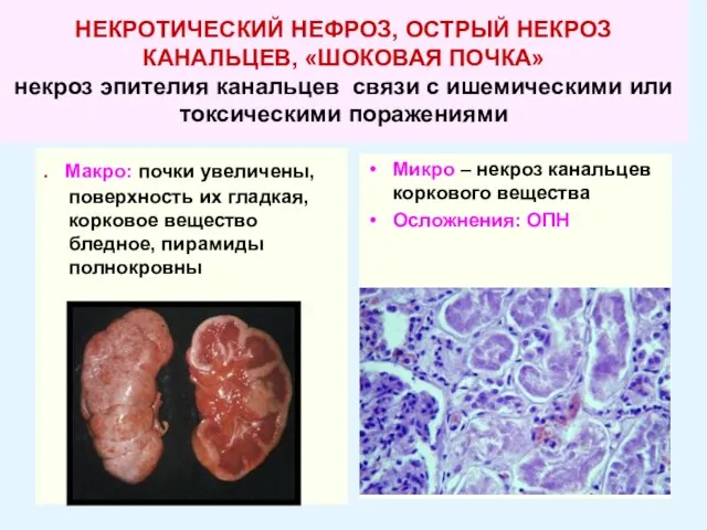 НЕКРОТИЧЕСКИЙ НЕФРОЗ, ОСТРЫЙ НЕКРОЗ КАНАЛЬЦЕВ, «ШОКОВАЯ ПОЧКА» некроз эпителия канальцев связи с