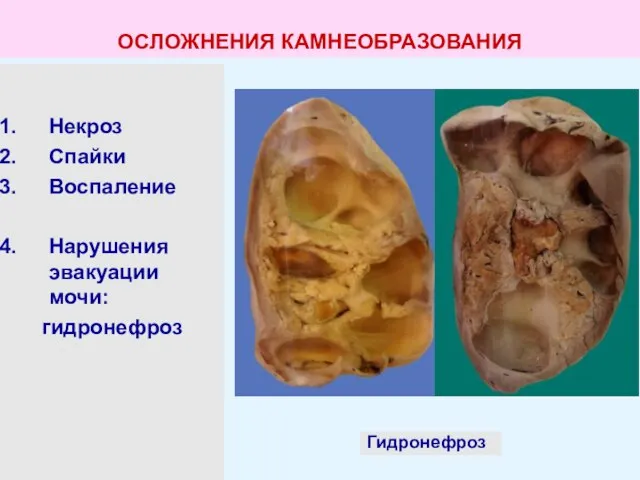 Некроз Спайки Воспаление Нарушения эвакуации мочи: гидронефроз Гидронефроз ОСЛОЖНЕНИЯ КАМНЕОБРАЗОВАНИЯ