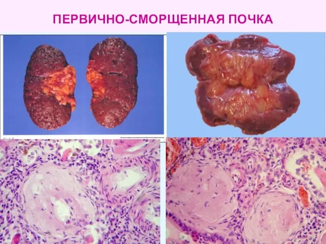 ПЕРВИЧНО-СМОРЩЕННАЯ ПОЧКА