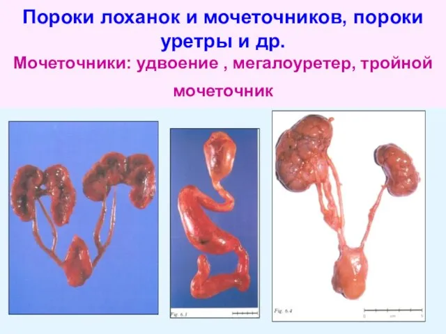 Пороки лоханок и мочеточников, пороки уретры и др. Мочеточники: удвоение , мегалоуретер, тройной мочеточник