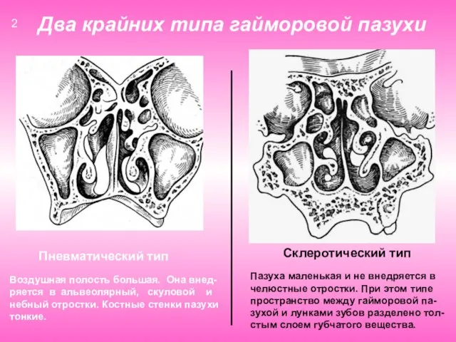 Два крайних типа гайморовой пазухи Пневматический тип Склеротический тип Воздушная полость большая.