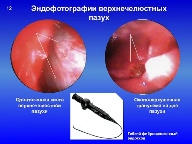 Гибкий фиброволоконный эндоскоп Эндофотографии верхнечелюстных пазух Одонтогенная киста верхнечелюстной пазухи Околоверхушечная гранулема на дне пазухи 12