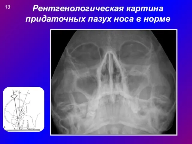 Рентгенологическая картина придаточных пазух носа в норме 13