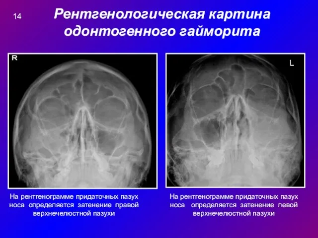 Рентгенологическая картина одонтогенного гайморита L На рентгенограмме придаточных пазух носа определяется затенение