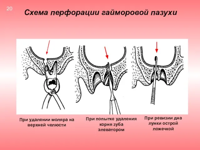 Схема перфорации гайморовой пазухи При удалении моляра на верхней челюсти При попытке