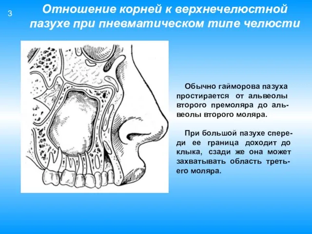 Обычно гайморова пазуха простирается от альвеолы второго премоляра до аль- веолы второго