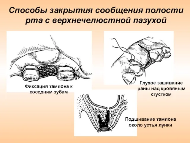 Способы закрытия сообщения полости рта с верхнечелюстной пазухой Фиксация тампона к соседним