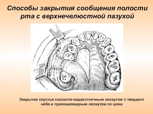 Способы закрытия сообщения полости рта с верхнечелюстной пазухой Закрытие соустья слизисто-надкостничным лоскутом