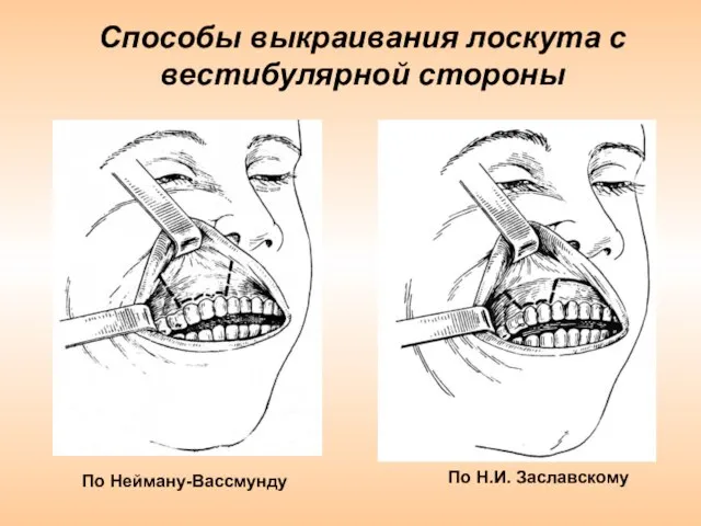 Способы выкраивания лоскута с вестибулярной стороны По Нейману-Вассмунду По Н.И. Заславскому