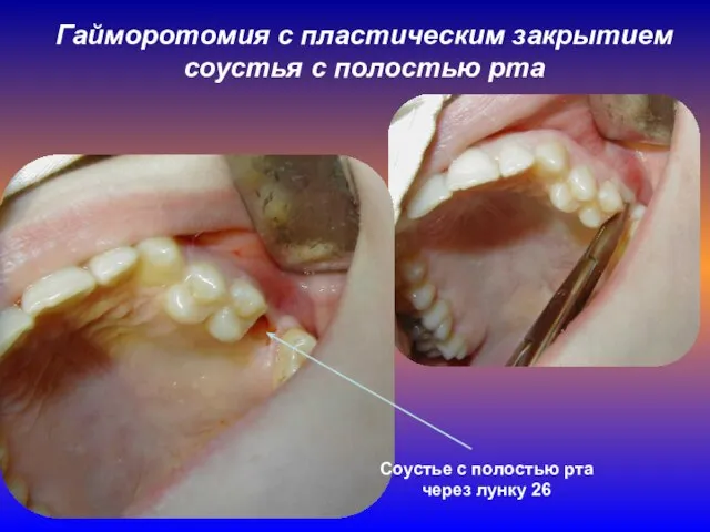 Гайморотомия с пластическим закрытием соустья с полостью рта Соустье с полостью рта через лунку 26