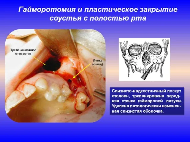 Гайморотомия и пластическое закрытие соустья с полостью рта Слизисто-надкостничный лоскут отслоен, трепанирована