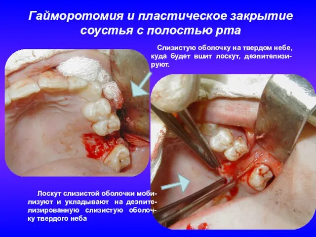 Гайморотомия и пластическое закрытие соустья с полостью рта Слизистую оболочку на твердом