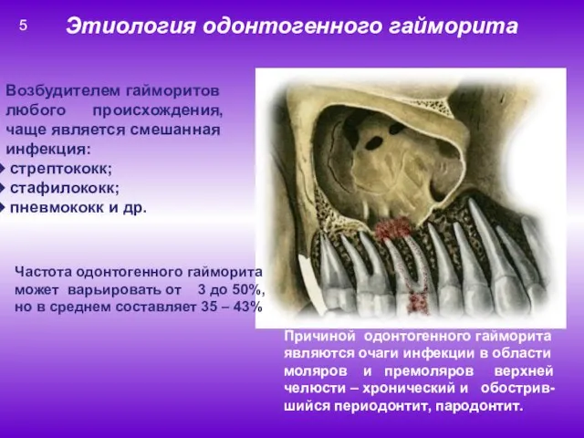 Причиной одонтогенного гайморита являются очаги инфекции в области моляров и премоляров верхней