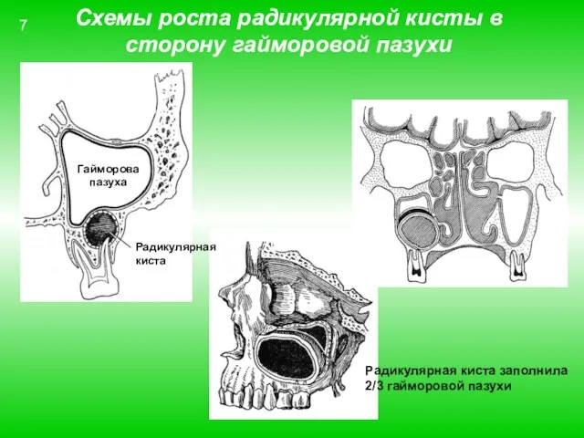 Схемы роста радикулярной кисты в сторону гайморовой пазухи Гайморова пазуха Радикулярная киста