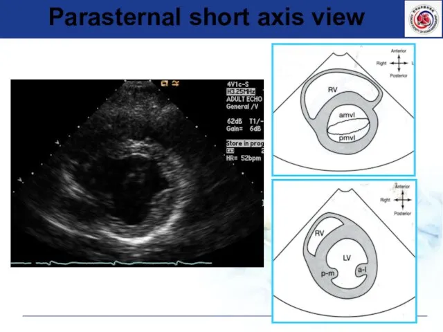 Parasternal short axis view