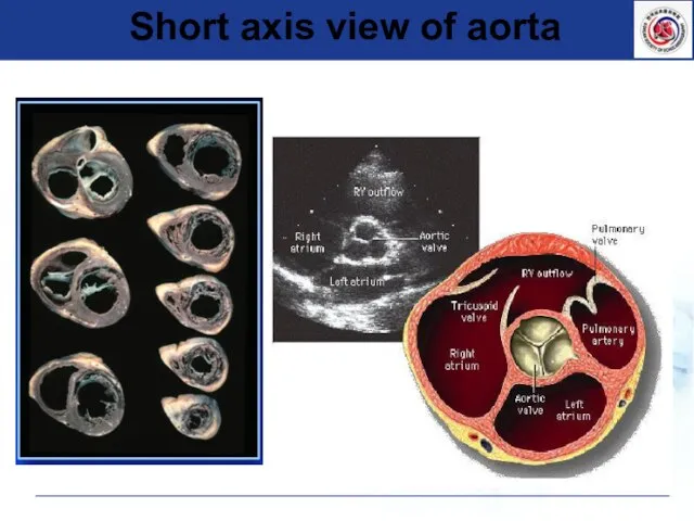 Short axis view of aorta