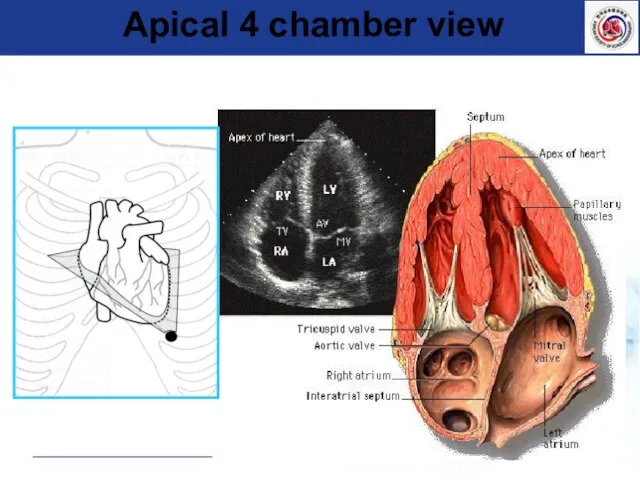 Apical 4 chamber view