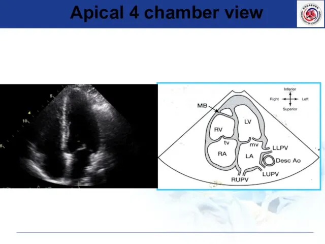 Apical 4 chamber view