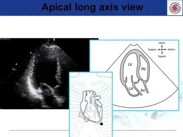 Apical long axis view