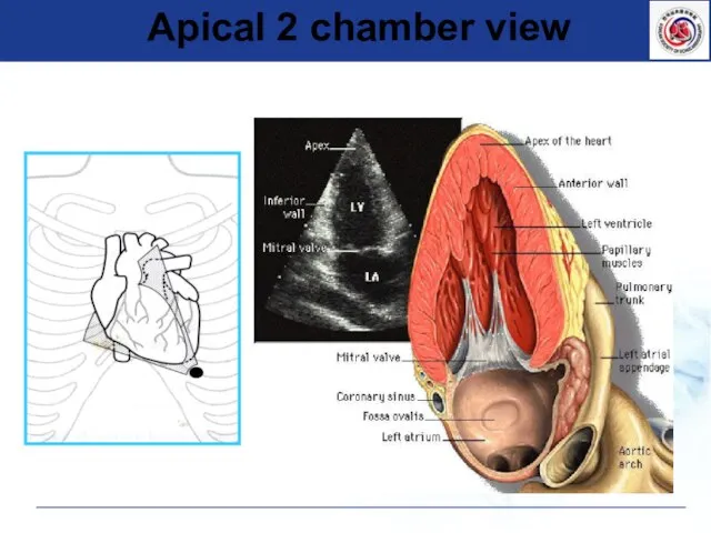 Apical 2 chamber view