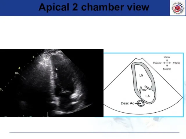 Apical 2 chamber view