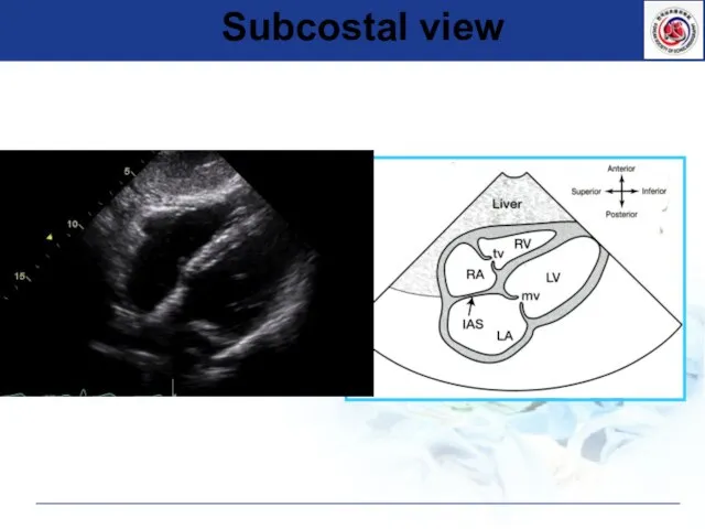 Subcostal view