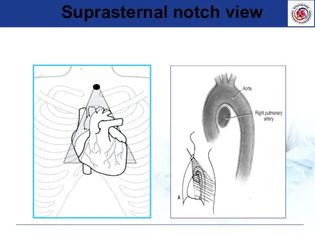 Suprasternal notch view